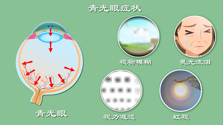 视物模糊？畏光流泪？细数第二大致盲眼病——青光眼致盲前有啥征兆？ - 知乎