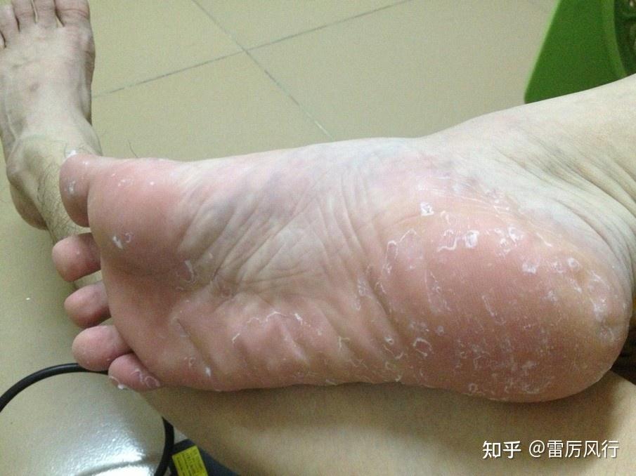 腳底和腳縫脫皮但是不癢是什麼原因啊怎麼才能治好