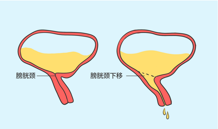 如何判断自己漏尿是否严重？ - 知乎
