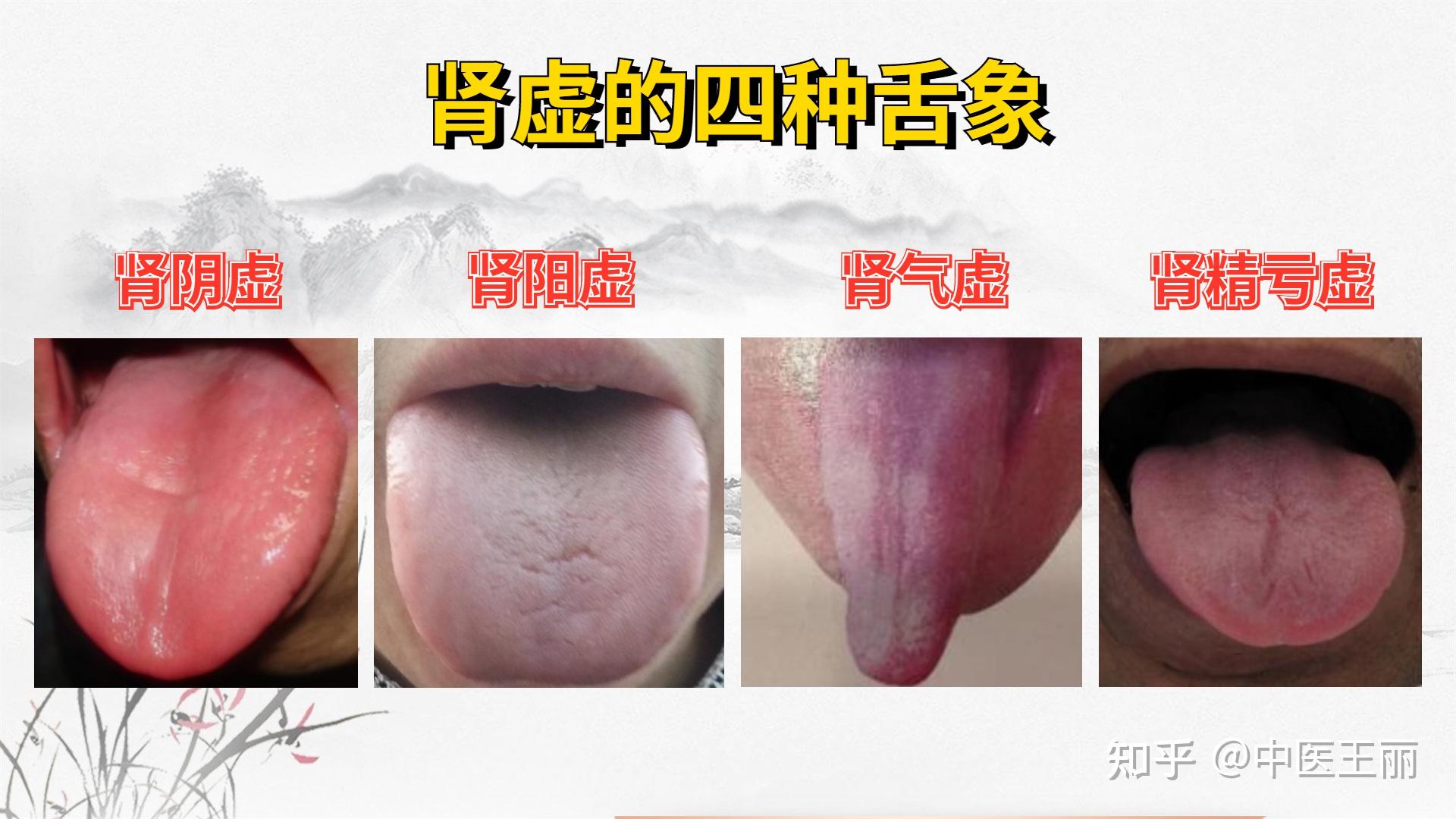 腎陰虛腎陽虛怎麼區分