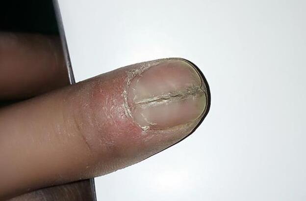 指甲开裂是怎么回事