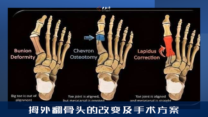 拇外翻如何有效矫正？拇外翻的矫正办法分享 - 知乎