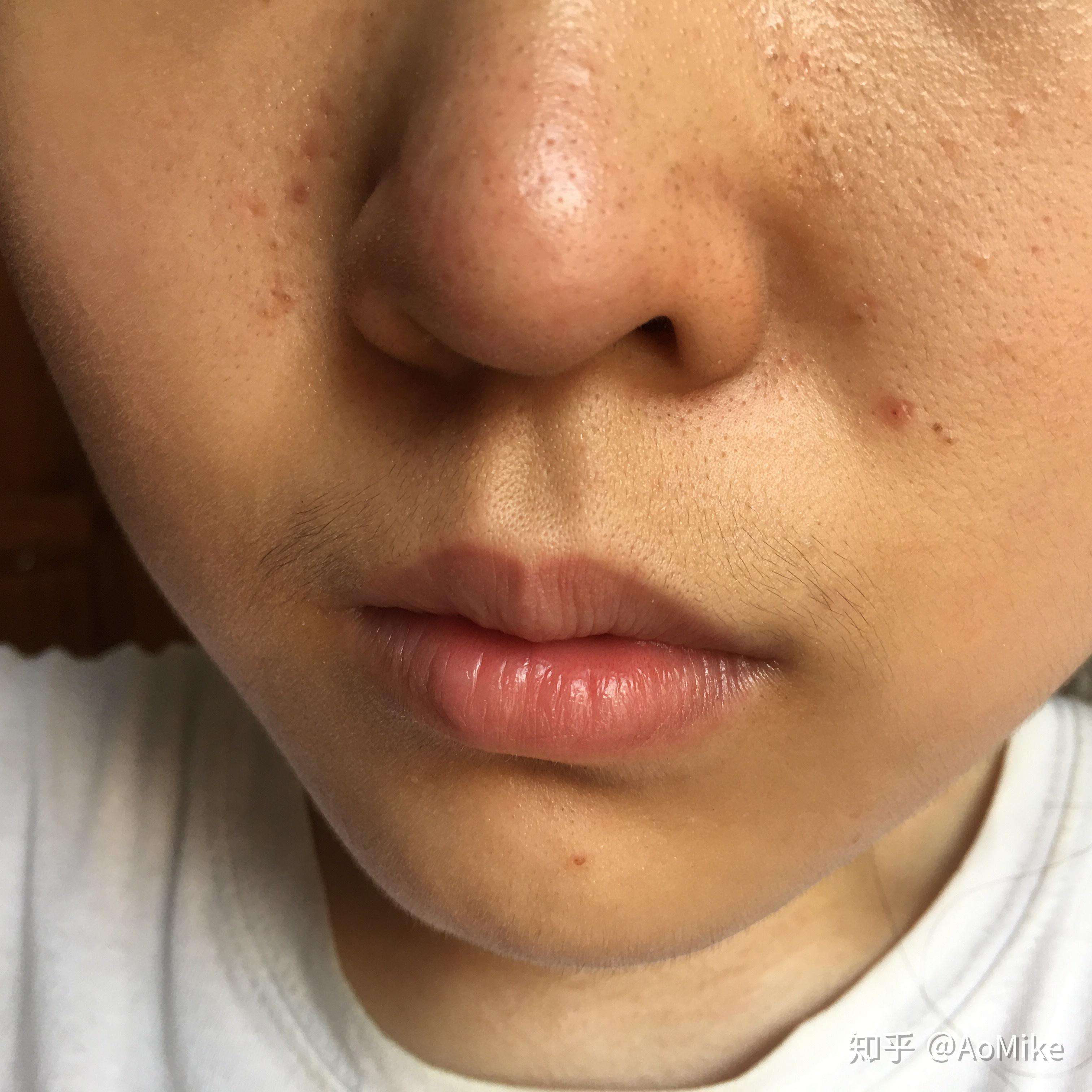 有木有脸上毛孔变大长出小黑毛的小伙伴