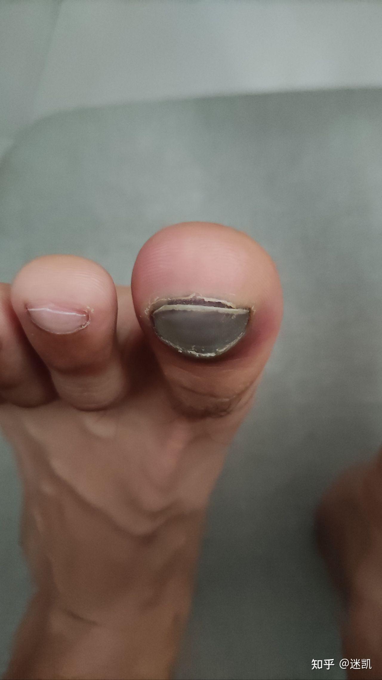 左脚大拇指被重物砸了 指甲内有淤血 特别疼 已经疼了一个晚上了 请问