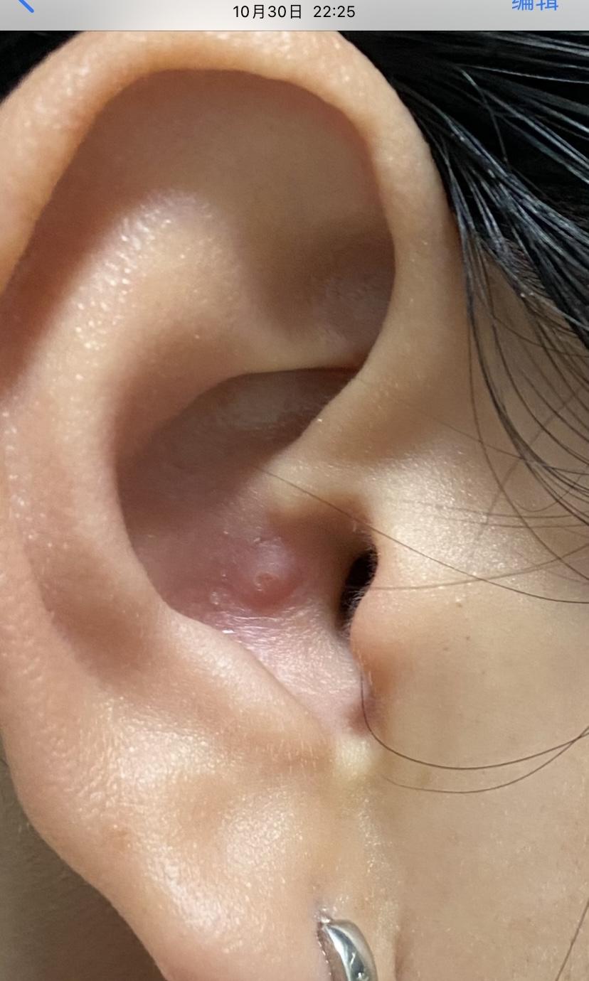耳廓皮肤疖肿图片