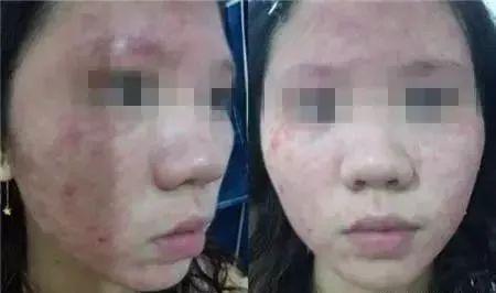 过敏了就是化妆品的错？最全皮肤过敏处理方法！必须人手一份~ - 知乎