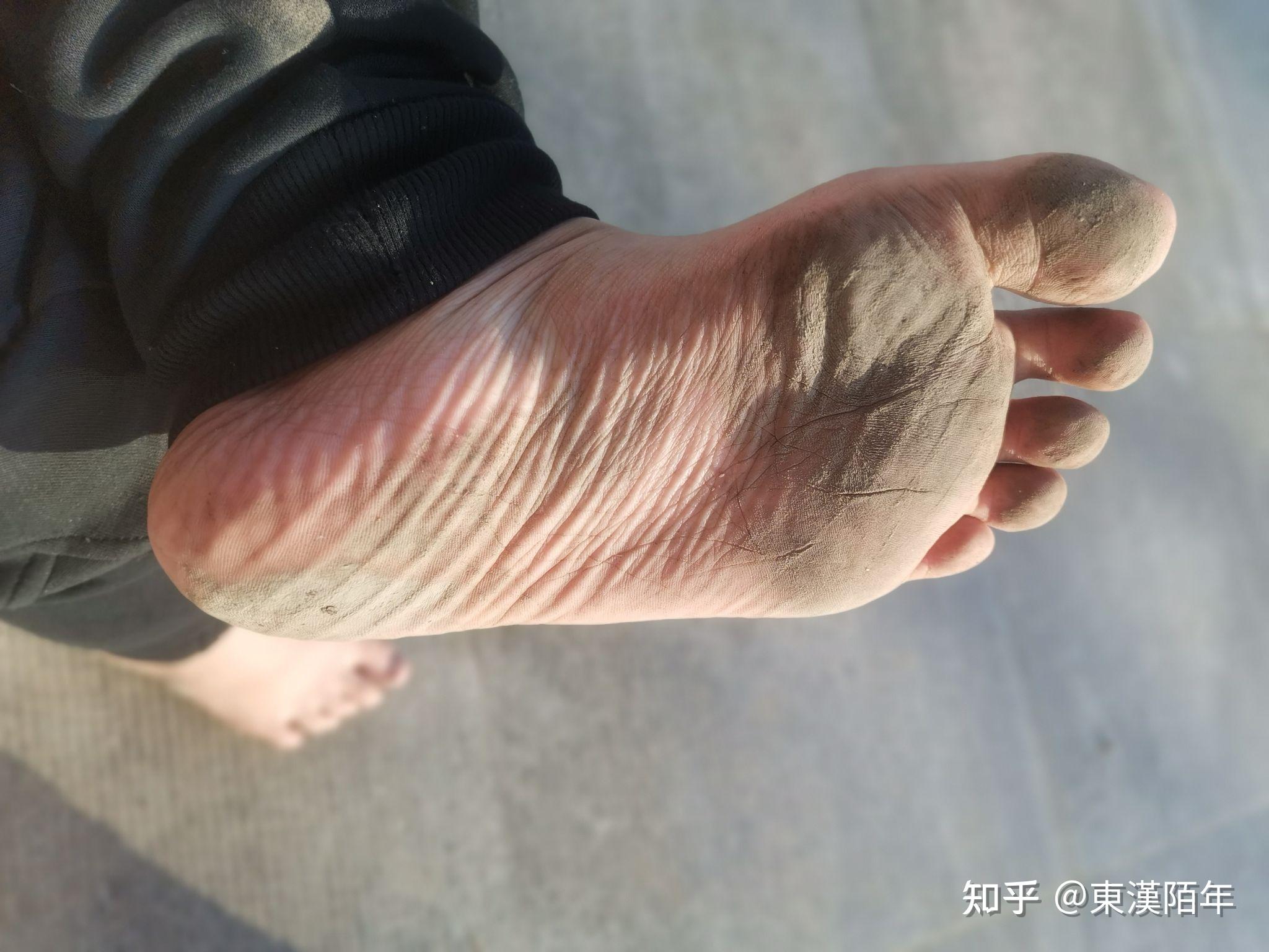 长期赤脚生活的脚底是什么样子的? - 知乎