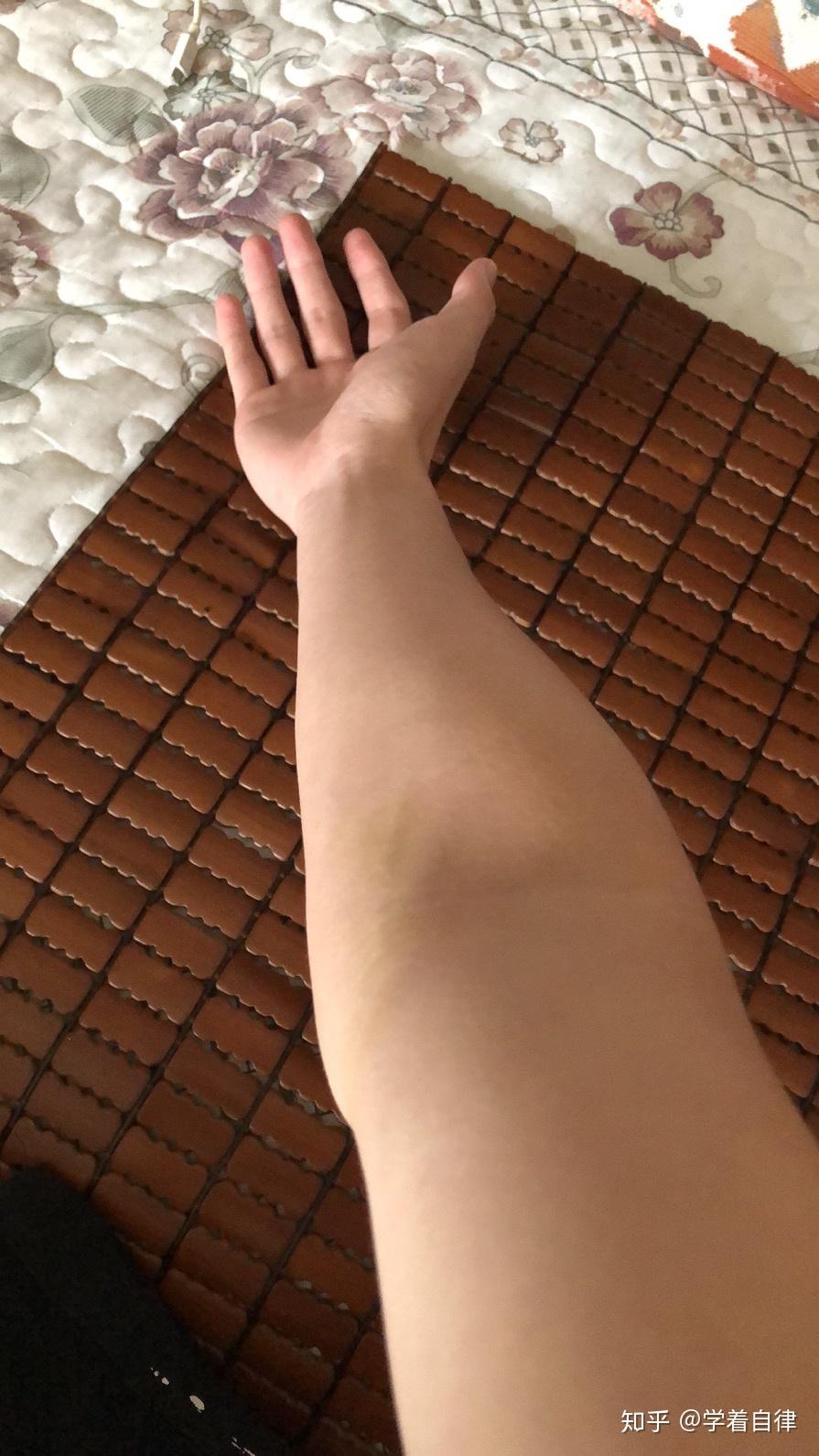 肘外翻是一种怎样的体验 如图?