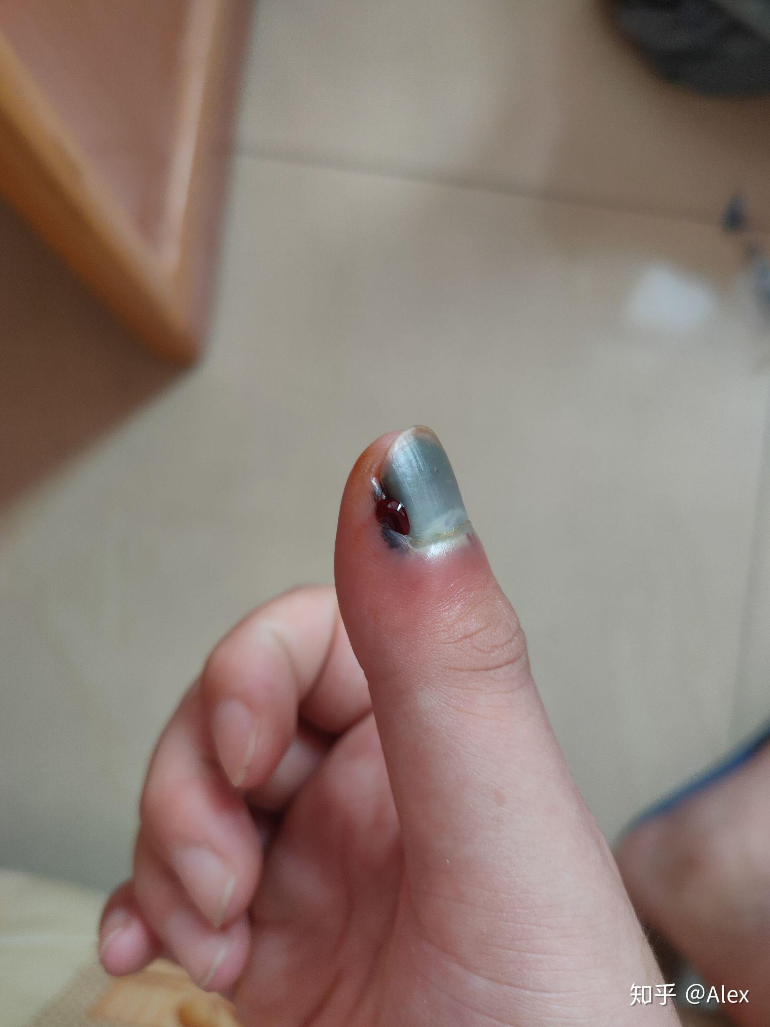 手指甲被夹到过了一段时间有黑色的淤血怎么处理