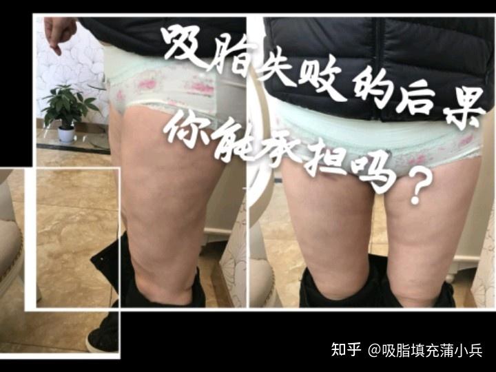 腰腹吸脂对于身体有没有伤害? - 知乎