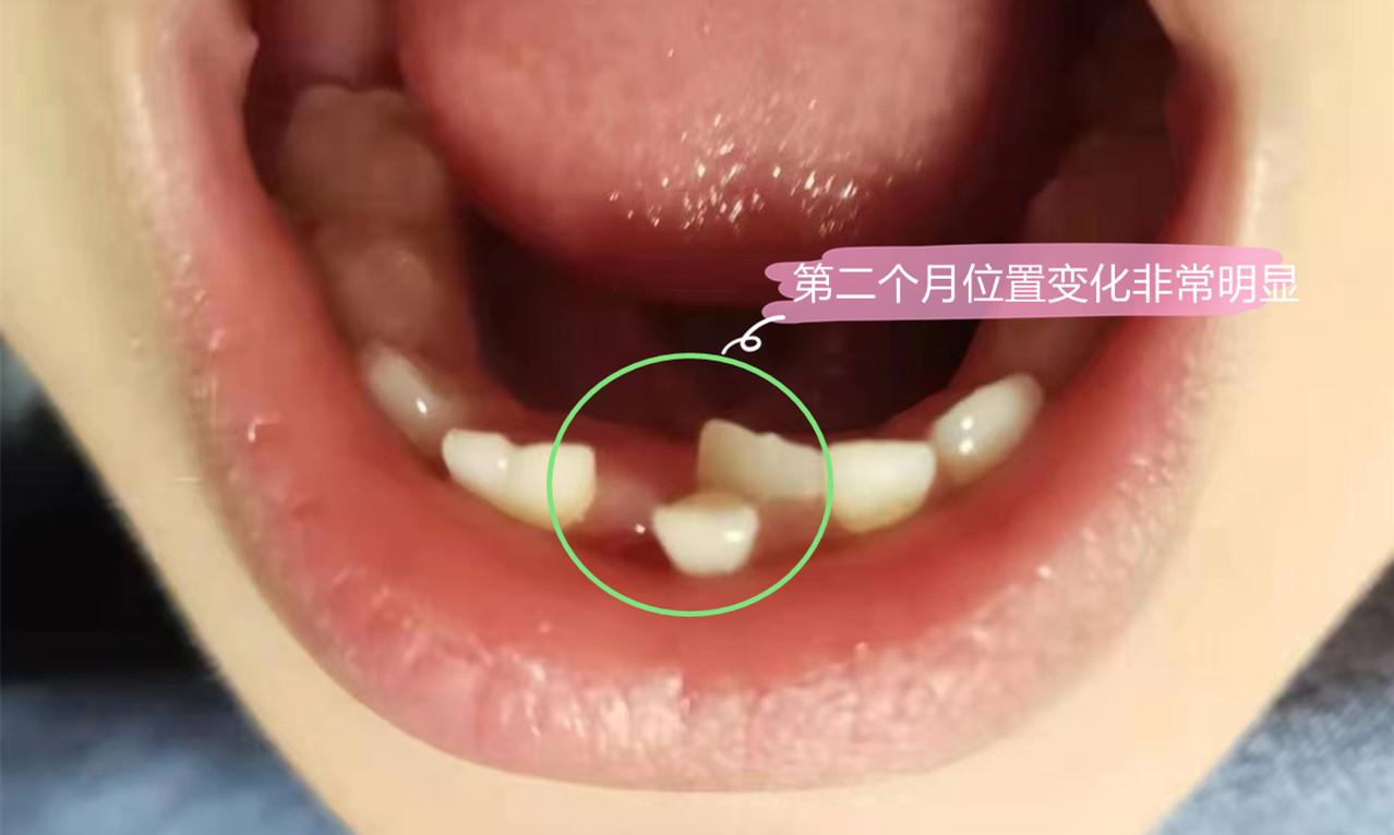 小孩换牙期牙齿要松了老不掉应该拔吗