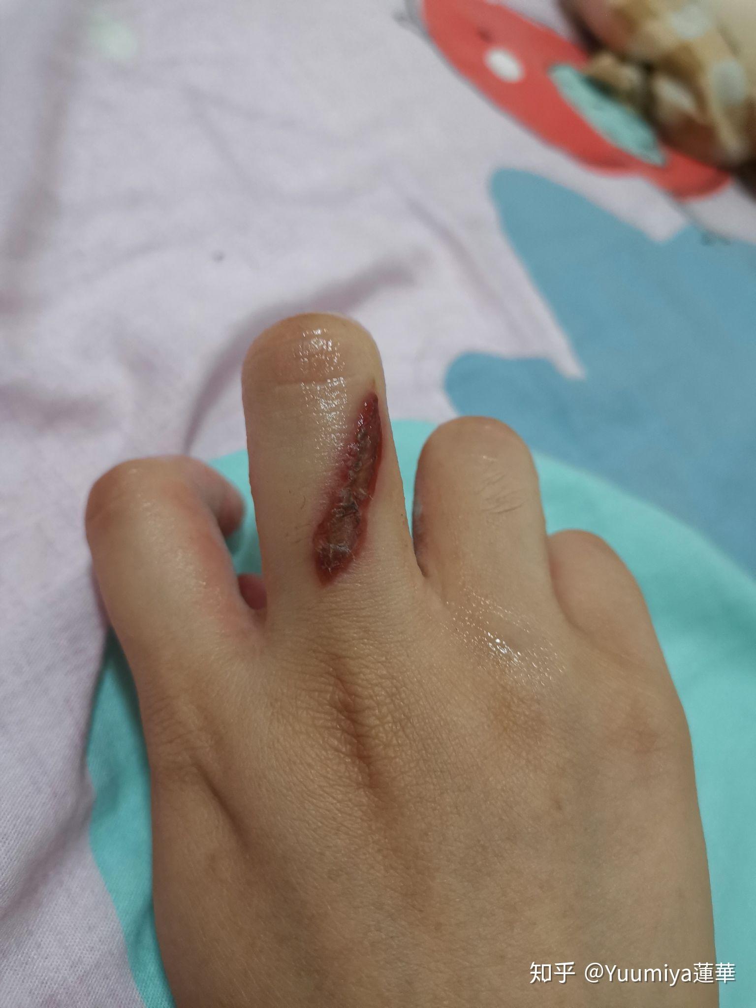 被电烙铁烫伤是一种什么样的体验?怎么处理不易留疤? - 知乎