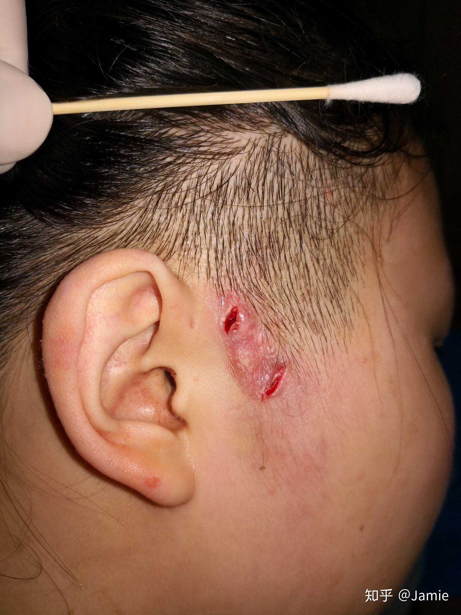 患有先天性耳前瘘管是一种怎样的体验? - 知乎