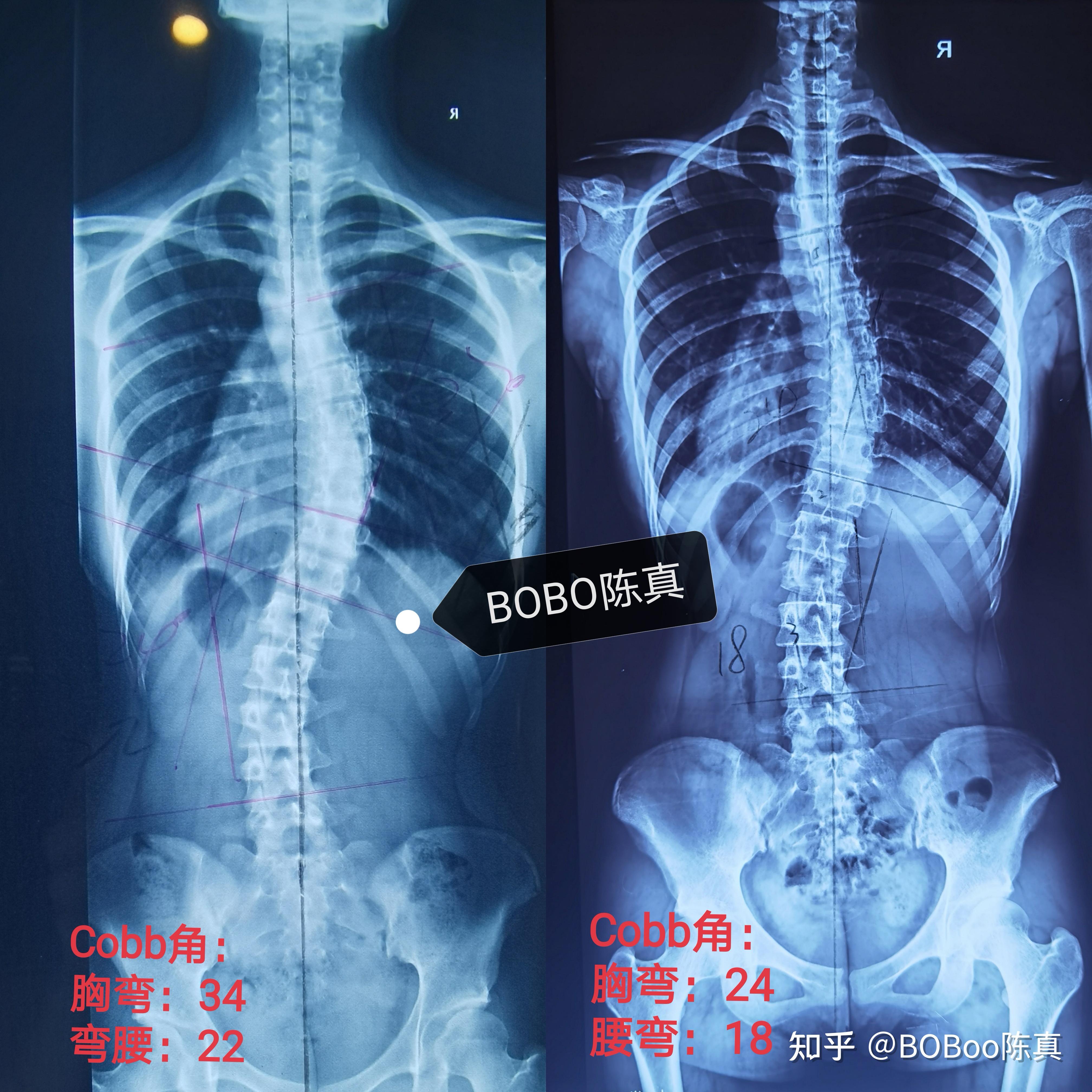 脊柱侧弯40度 外观图片