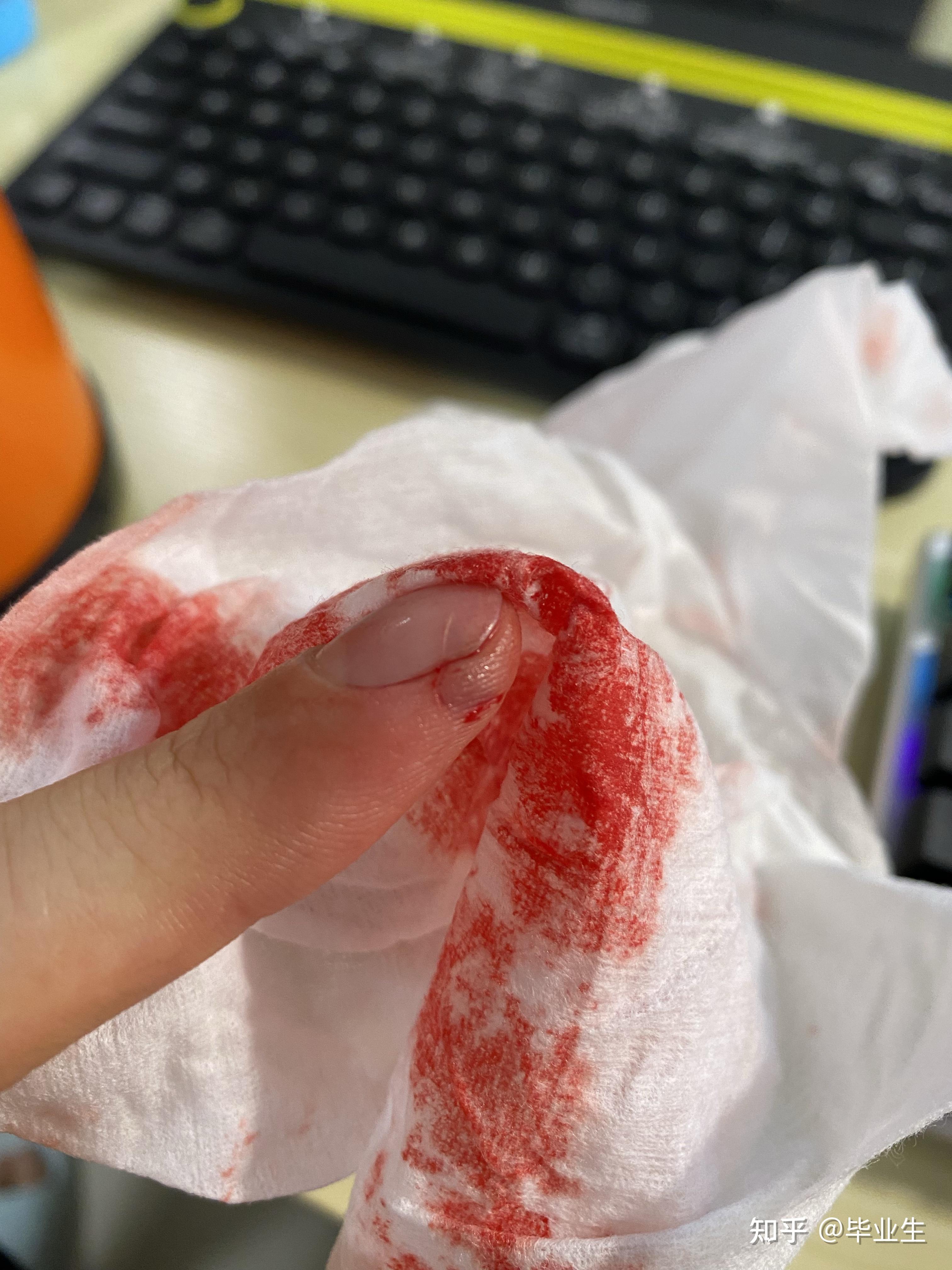 切菜切到手该怎么办? - 知乎