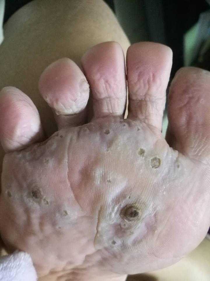 困扰六年多的跖疣终于治好了