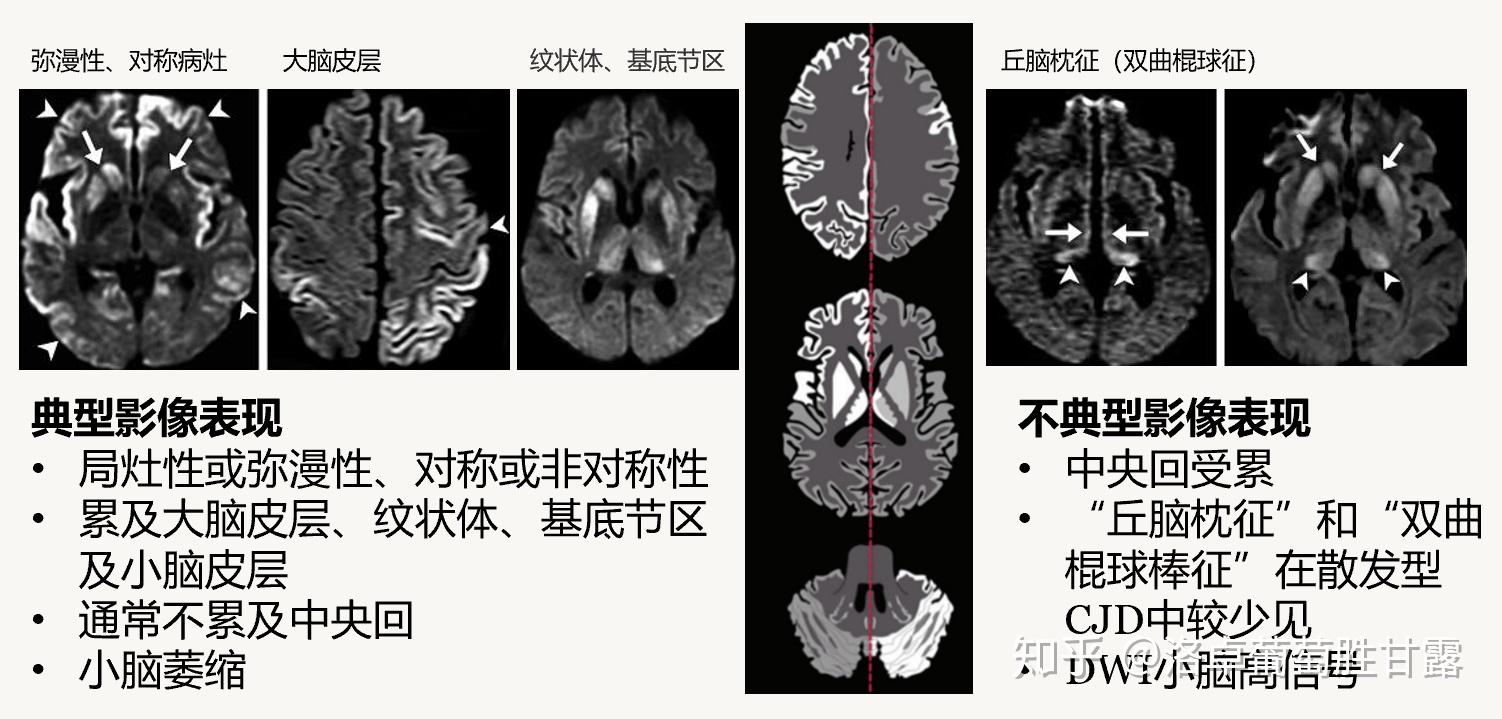 朊病毒侵犯大腦具體是侵犯什麼腦區呢