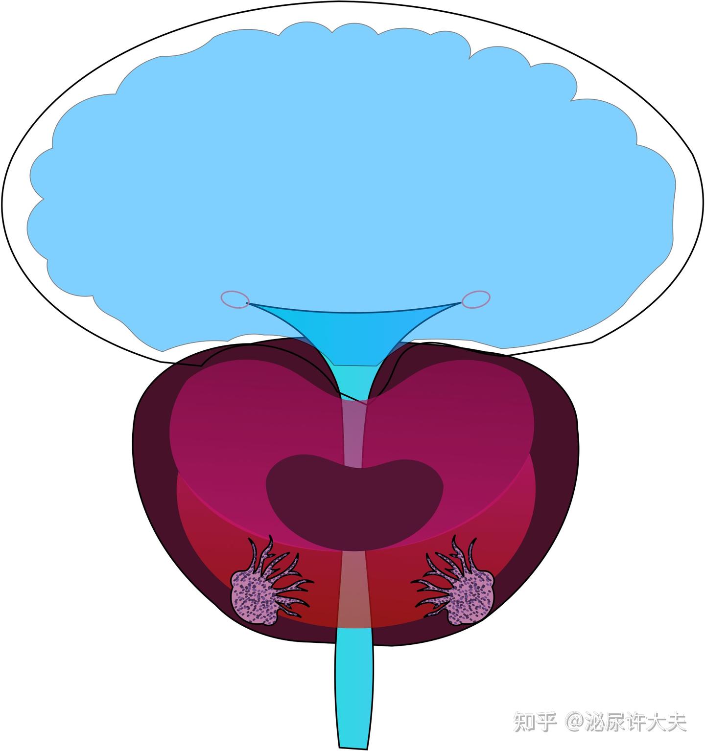 如何评估前列腺癌恶性程度？ - 知乎