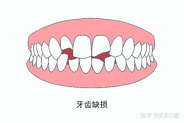 牙体、牙列缺损与牙列缺失的区别! - 知乎