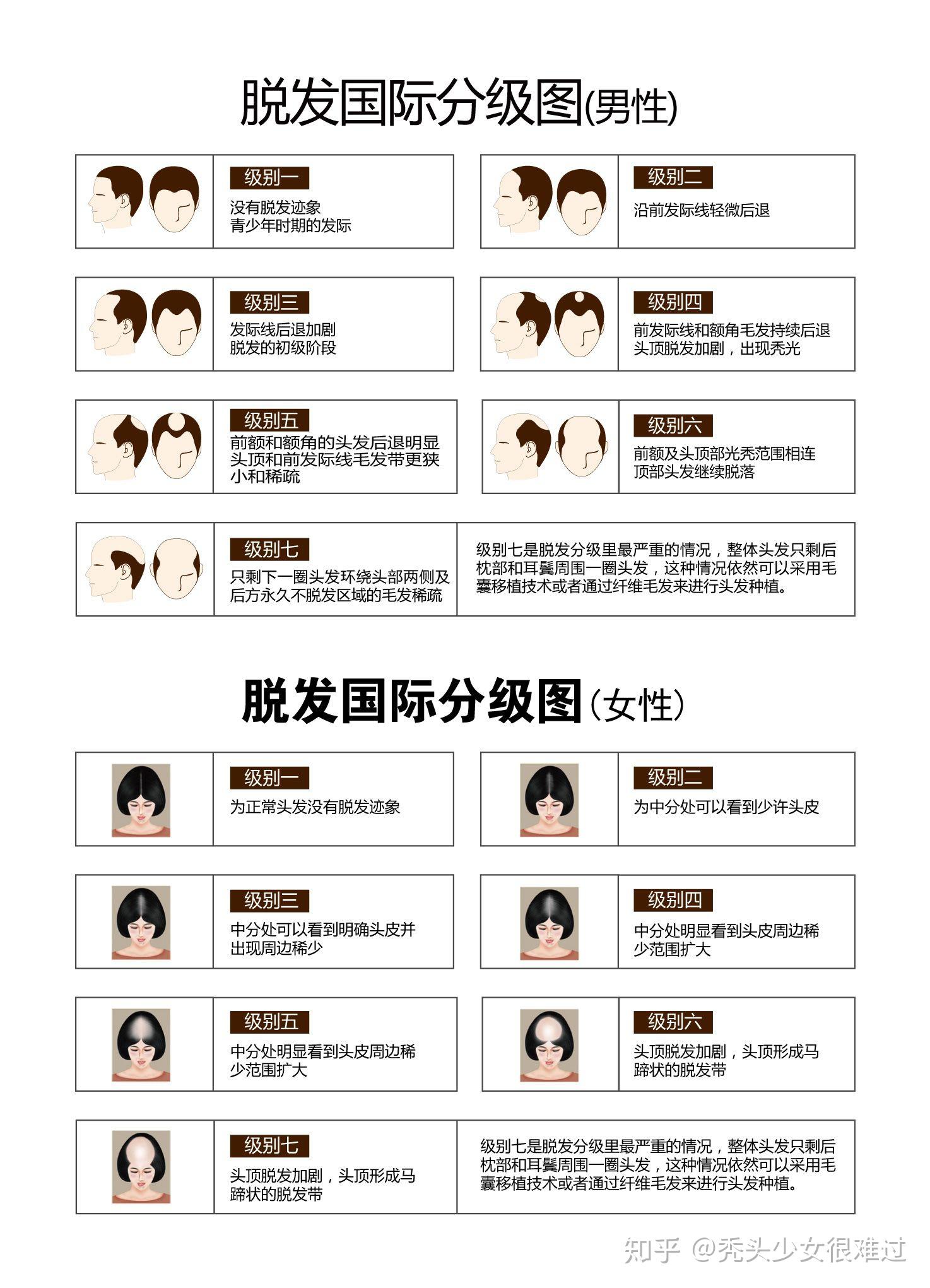 怎么判断自己的脱发类型? - 知乎