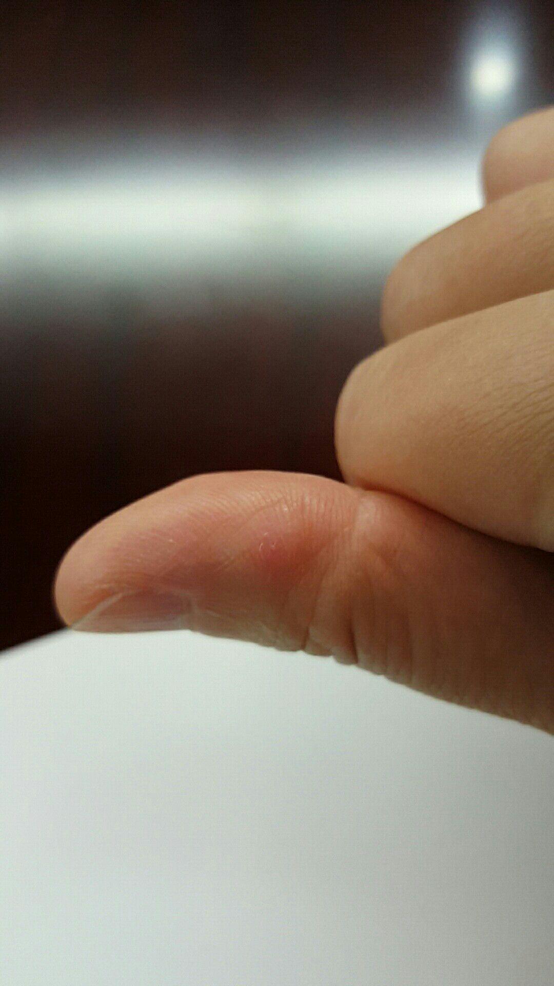 如果仙人掌的刺扎进人肉里没能被挑出那它会自己从肉里排出来或被吸收
