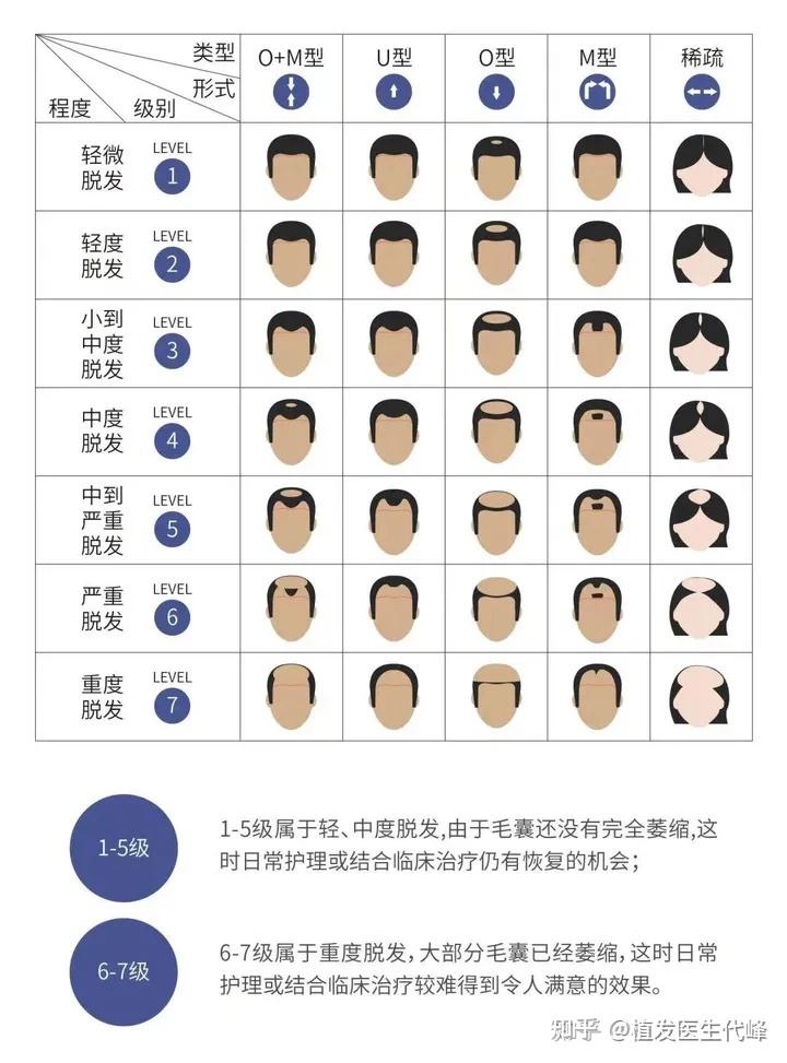 遗传性脱发基因究竟是遗传自爸爸还是妈妈?遗传性脱发有得治吗?