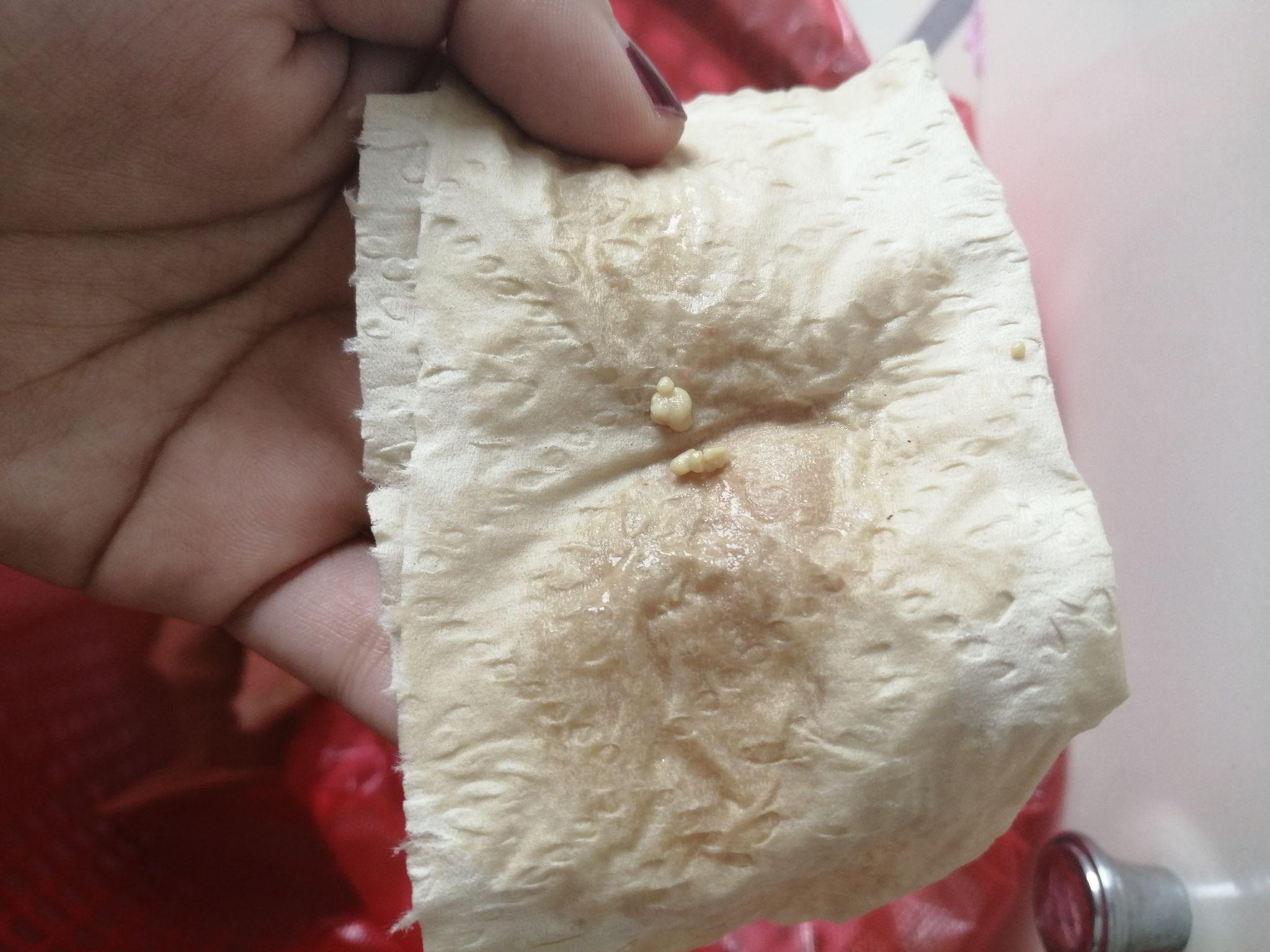 你见过最大的扁桃体结石有多大? - 知乎