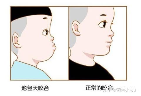 你的反颌(地包天)正畸矫正成功了吗? - 知乎