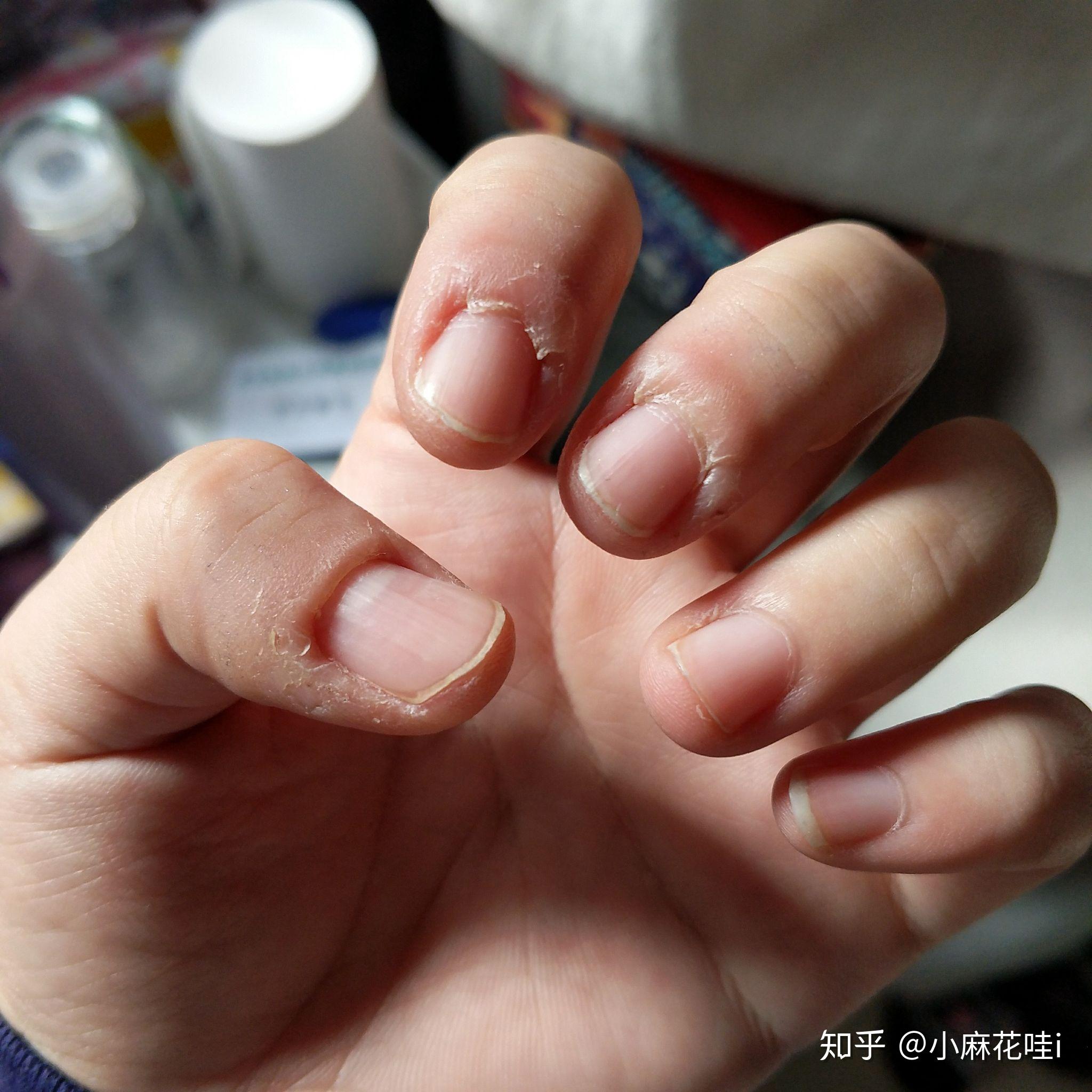 成年人如何改掉抠手的习惯有什么心理学道理