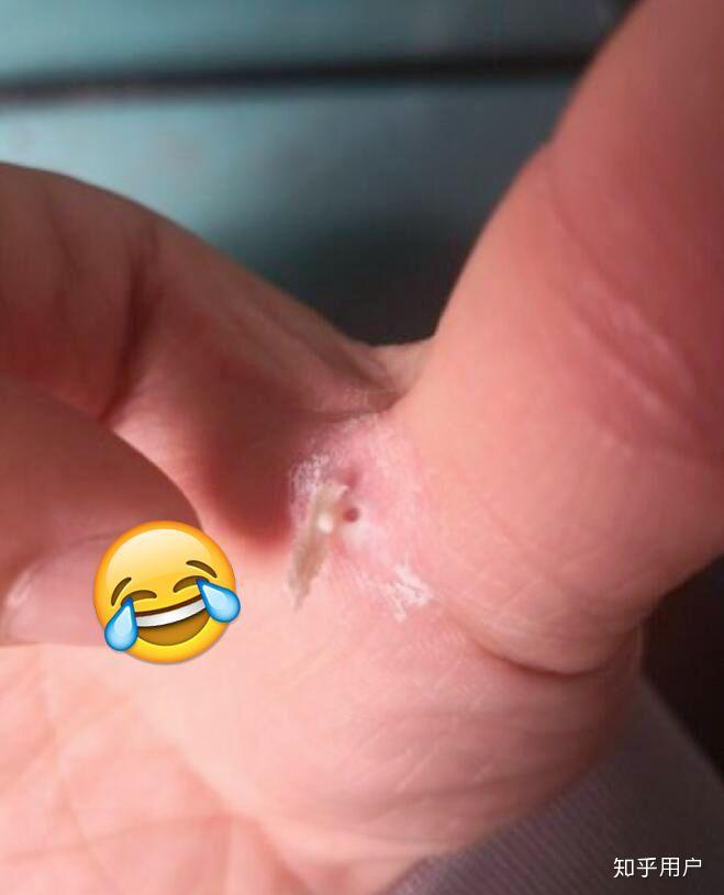 鸡眼到底有没有根刺