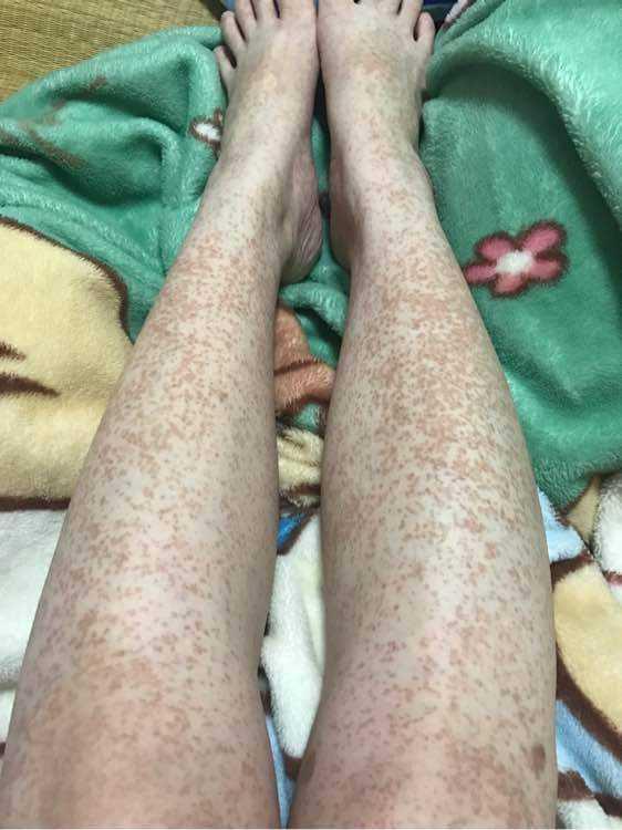 能出现淤点的病症有很多如何诊断是紫癜呢