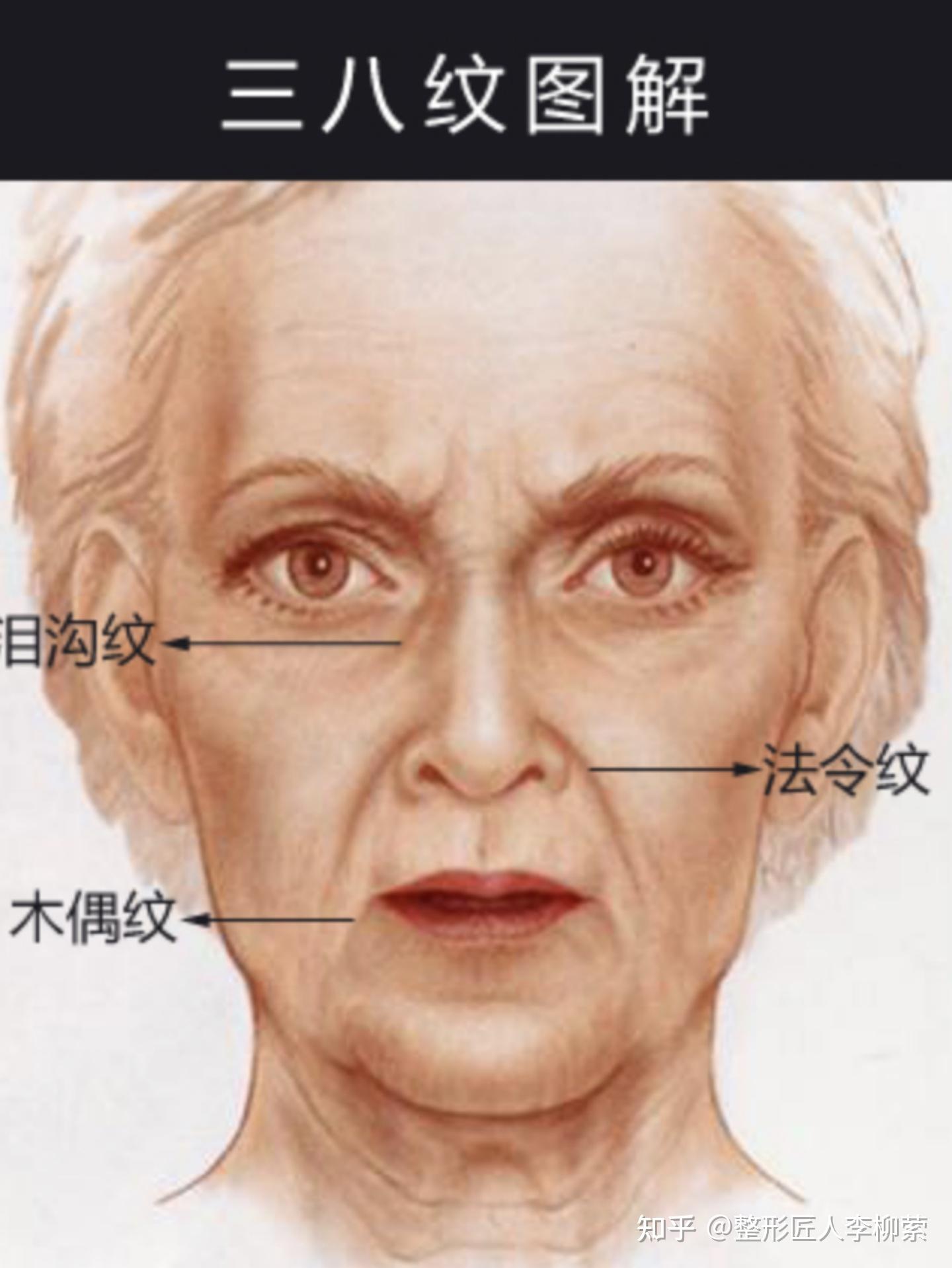 嘴角纹怎么办求救