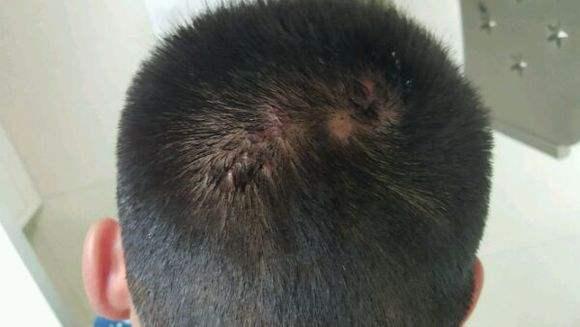 秃发性毛囊炎怎么治