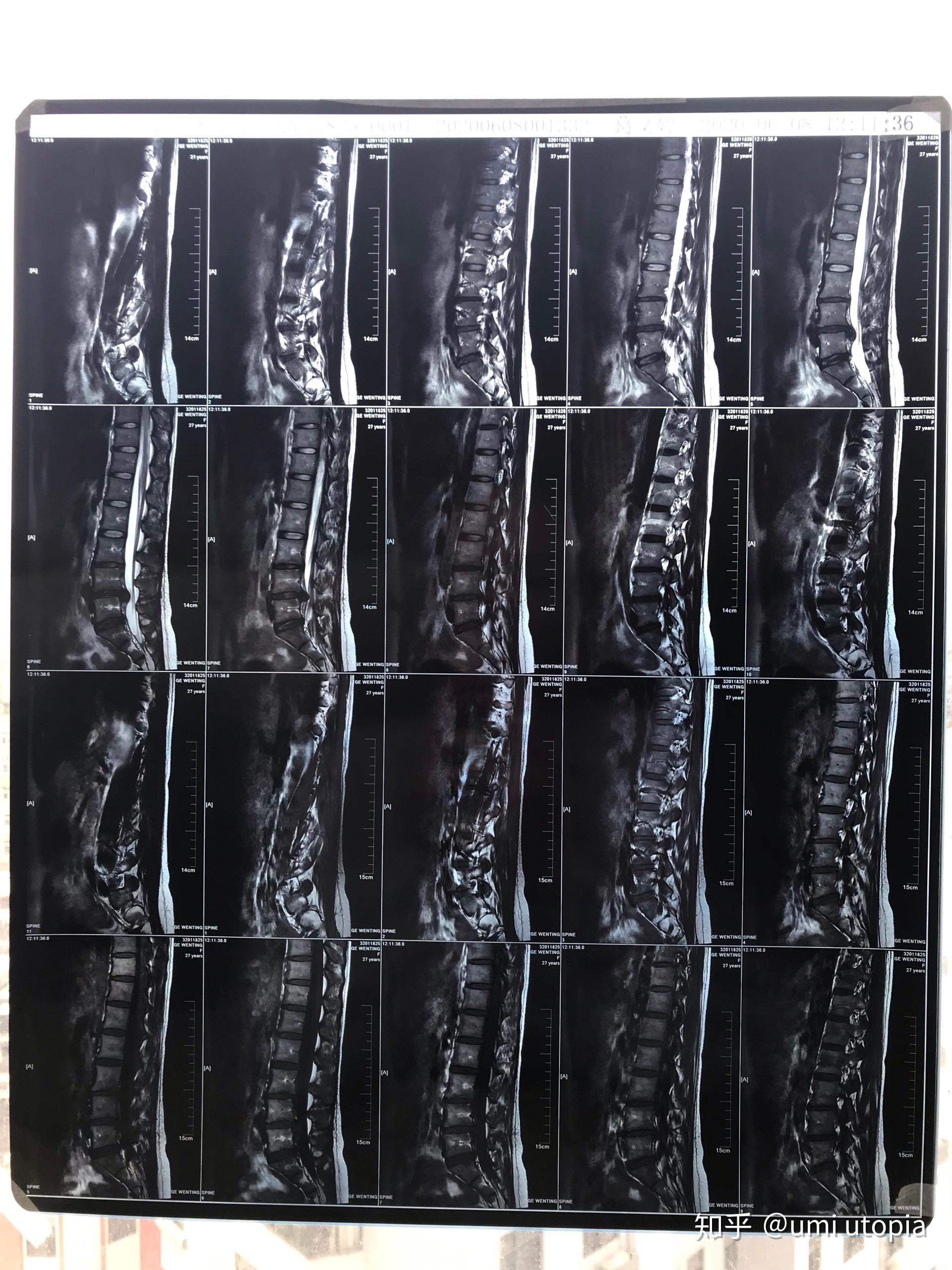 27岁,腰椎间盘l5s1突出压迫右侧神经,附核磁共振,到要手术的程度了吗?