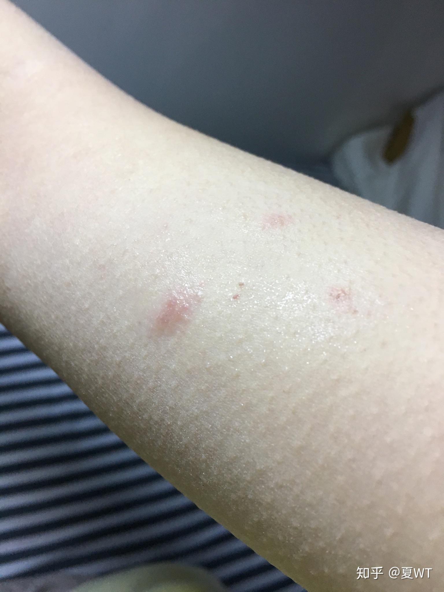 有图求专业人士帮忙看一下这是不是丘疹性荨麻疹