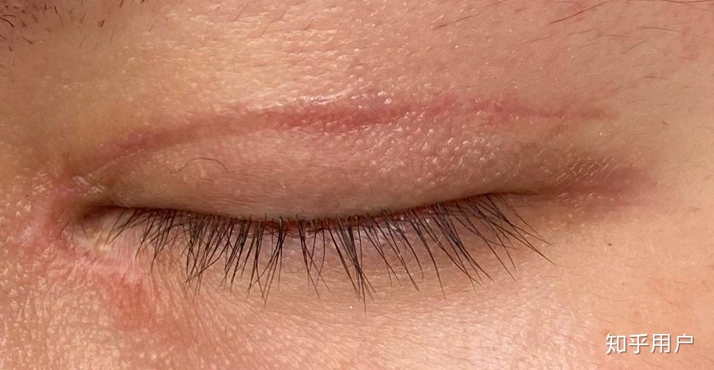 割双眼皮后疤痕增生怎么办? - 知乎