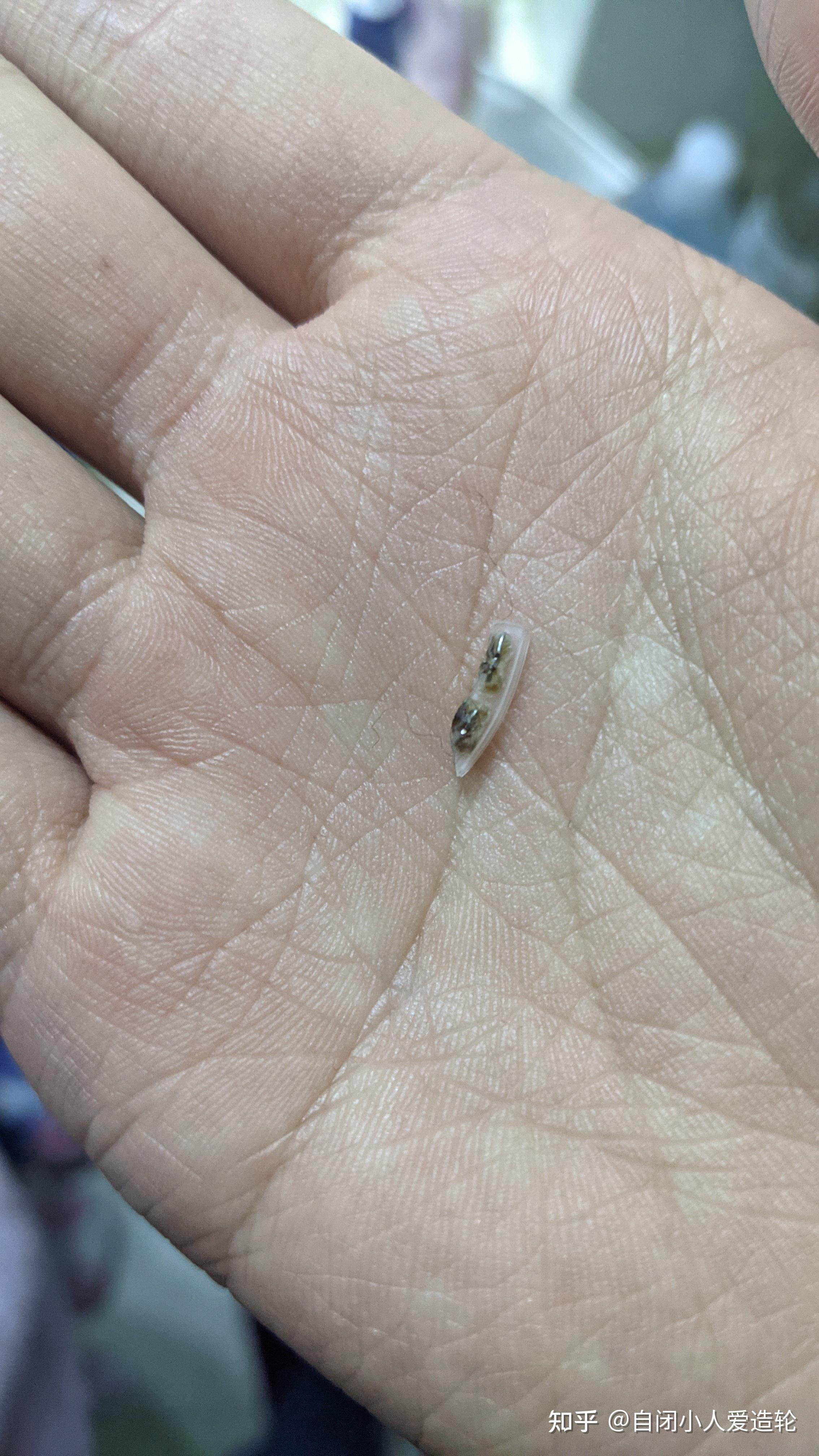 26岁新生：包皮环切手术 - 知乎