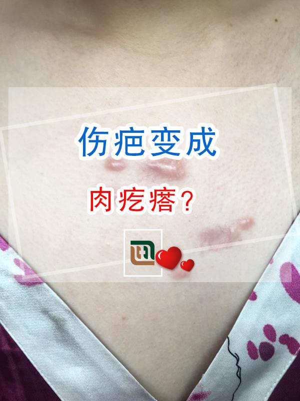 伤疤变成肉疙瘩? - 知乎