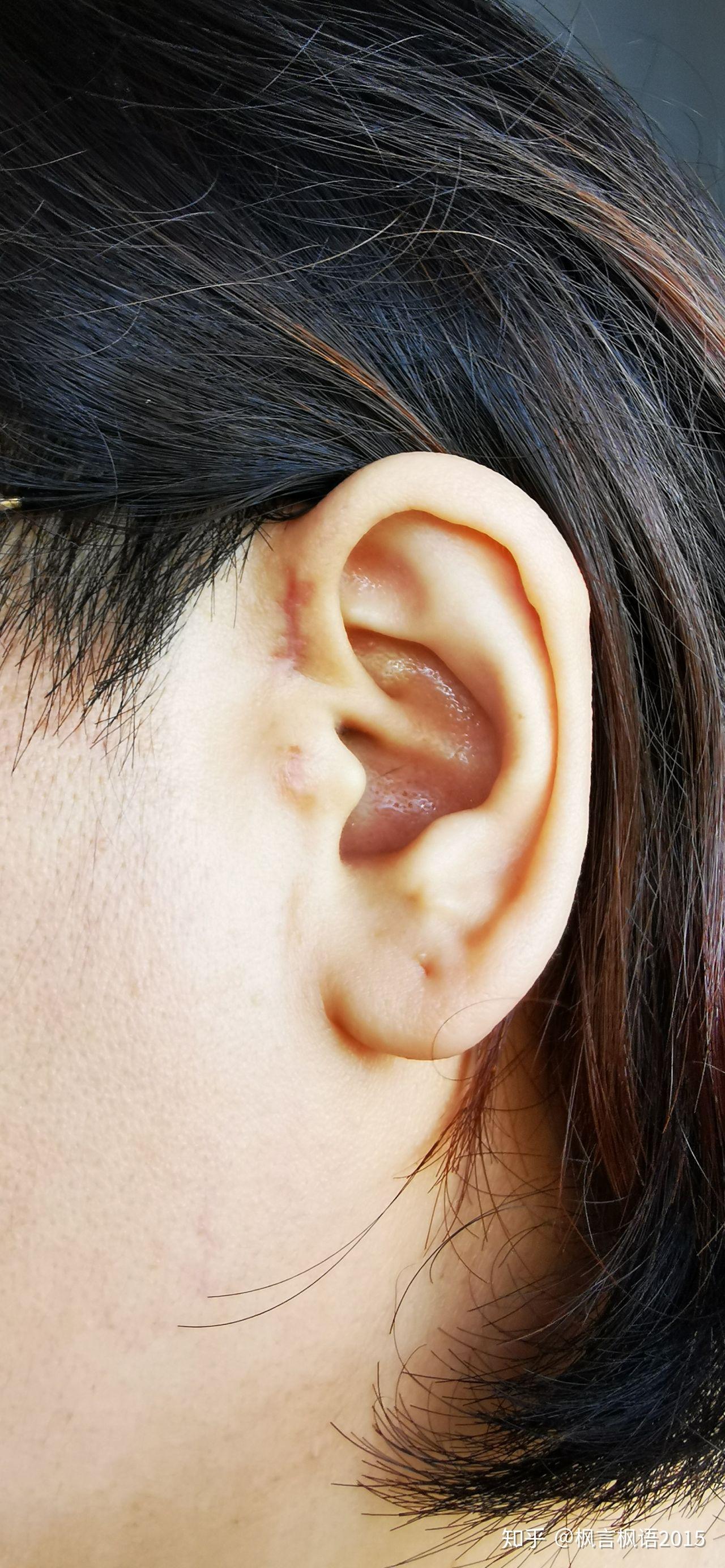 耳前瘘管|耳前瘘管|感染型|超声|脓肿|先天耳畸形|-健康界