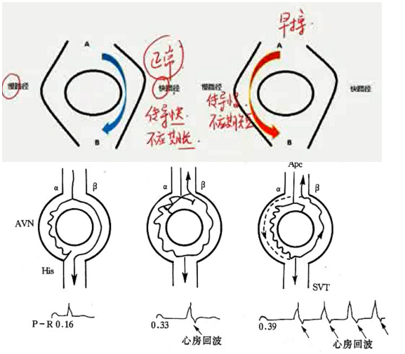 药理学03-2:抗心律失常药物(antiarrhythmic drugs) - 知乎