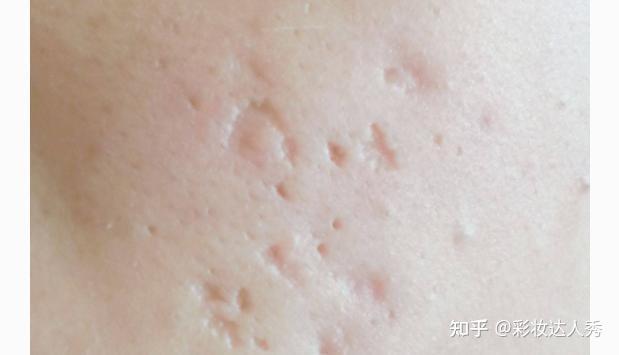 痘痘经常在同一个地方复发?痘痘是否真有“痘根”一说 - 知乎