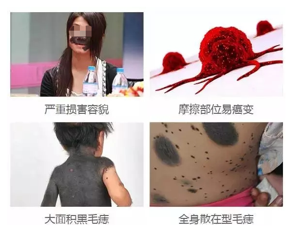 胎记治疗效果怎么样?与哪些因素有关系? - 知乎