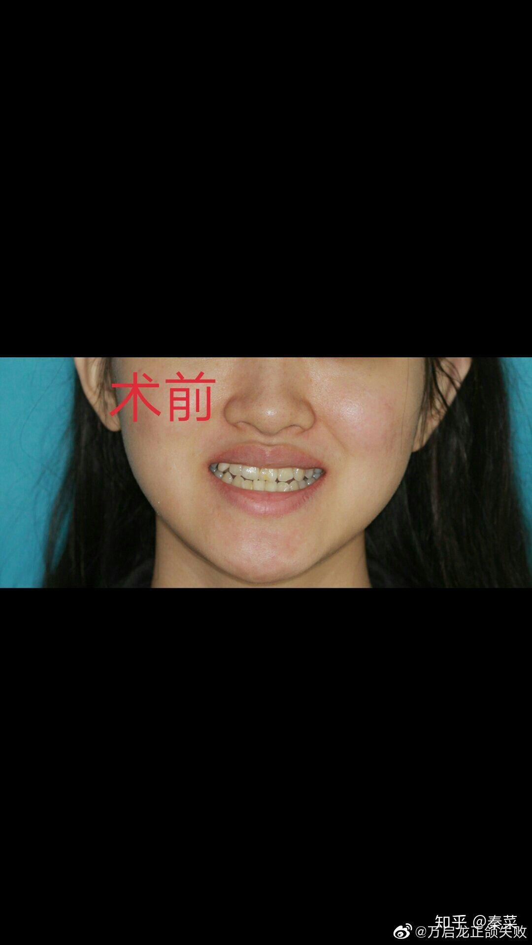 正颌手术失败的你现在怎样了