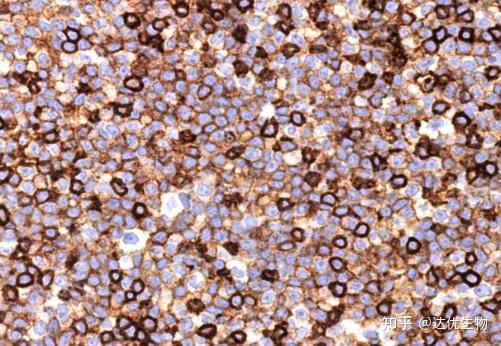 CD3、CD20…揭秘淋巴瘤免疫组化报告上的“CD家族” - 知乎