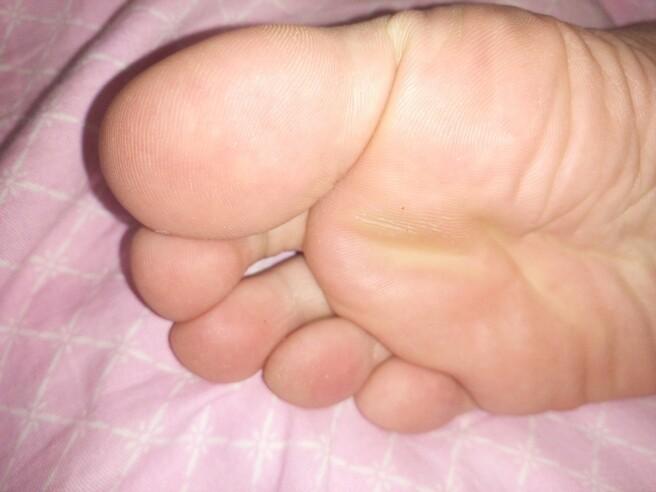 脚上这样茧子怎么治啊