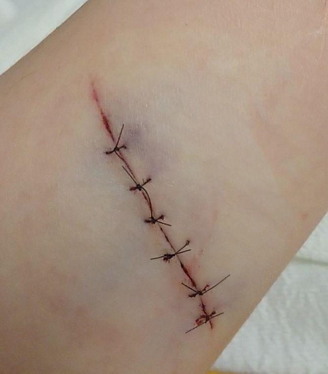 缝针和拆线可怕吗疼吗你们当时怕吗