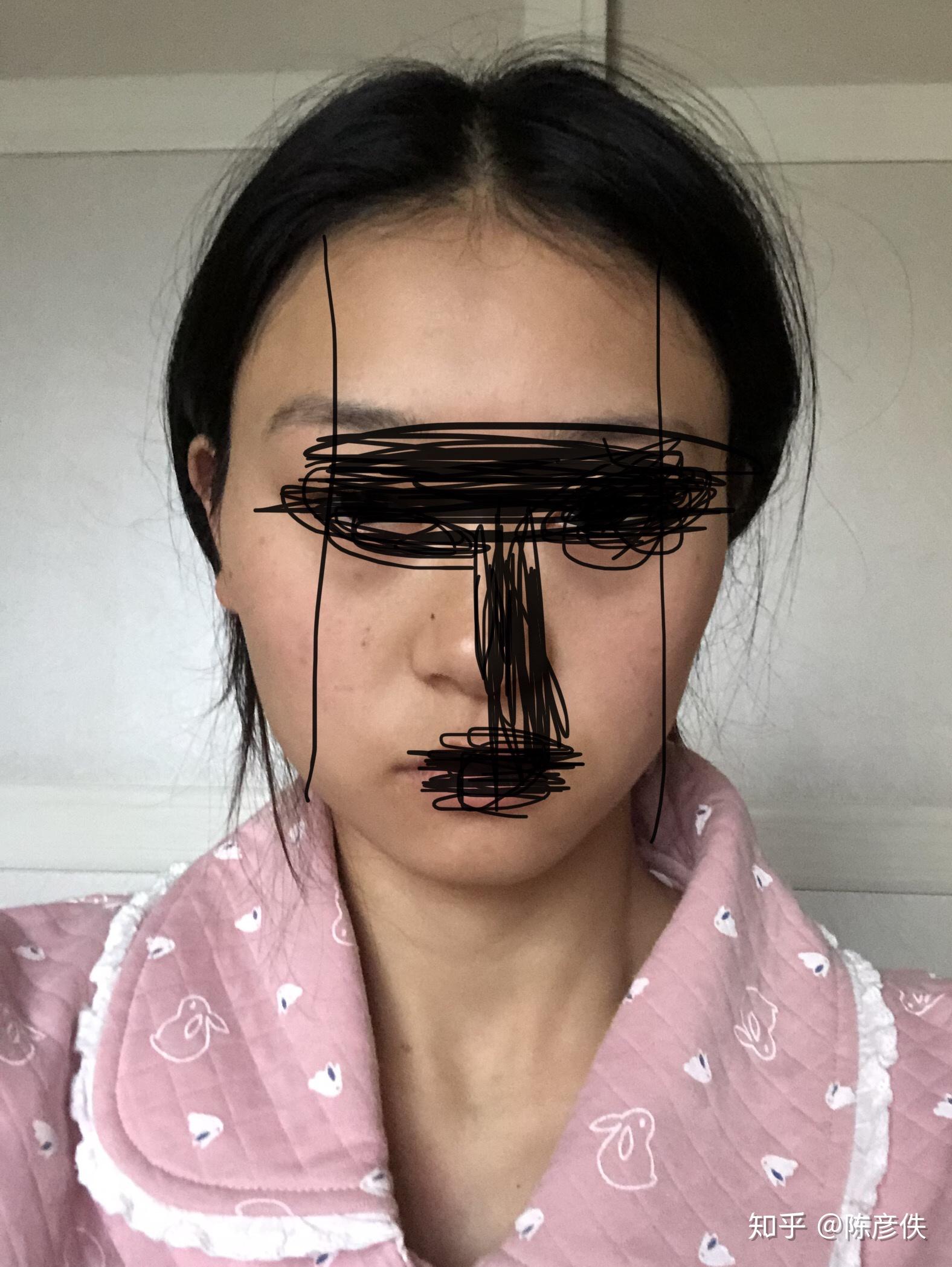 长期单侧咀嚼导致一边脸大一边脸小怎么恢复