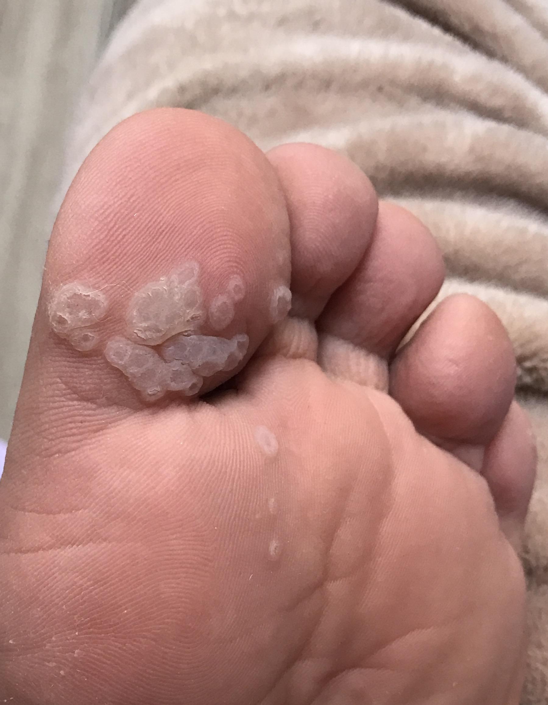 跖疣怎样才能治好? - 知乎