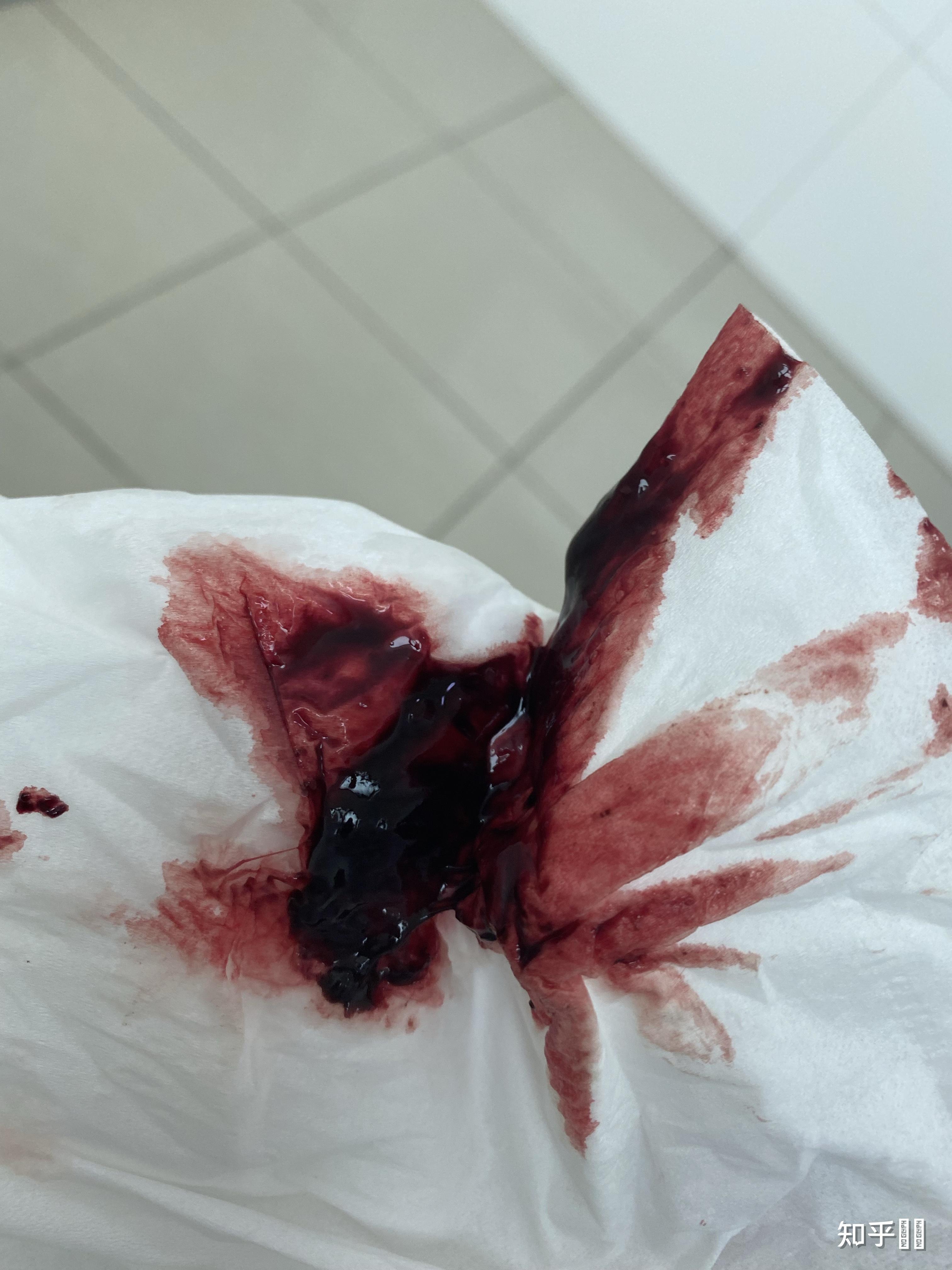 药流后20天,有14mm×3.