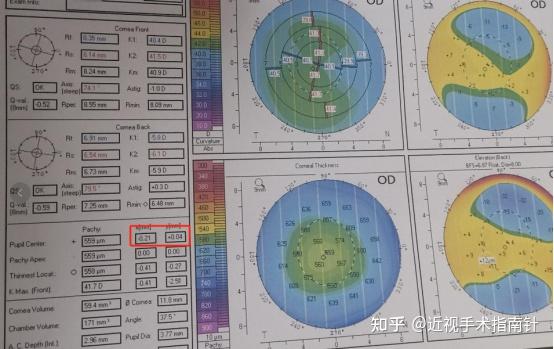 角膜地形图上看kappa角图片